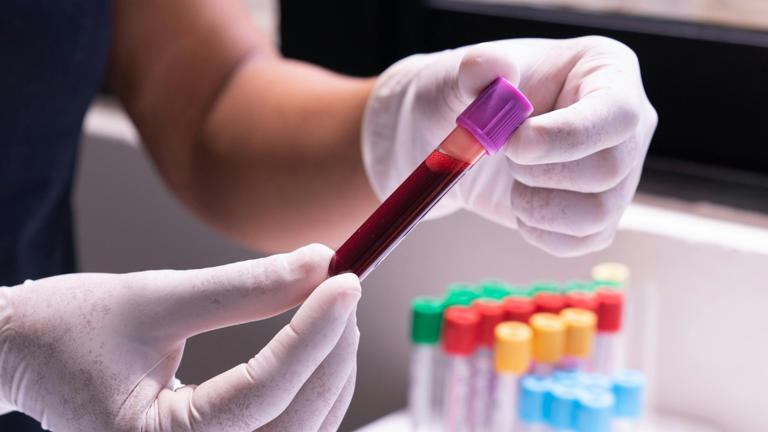 AI model flags multiple dementias from a single blood sample