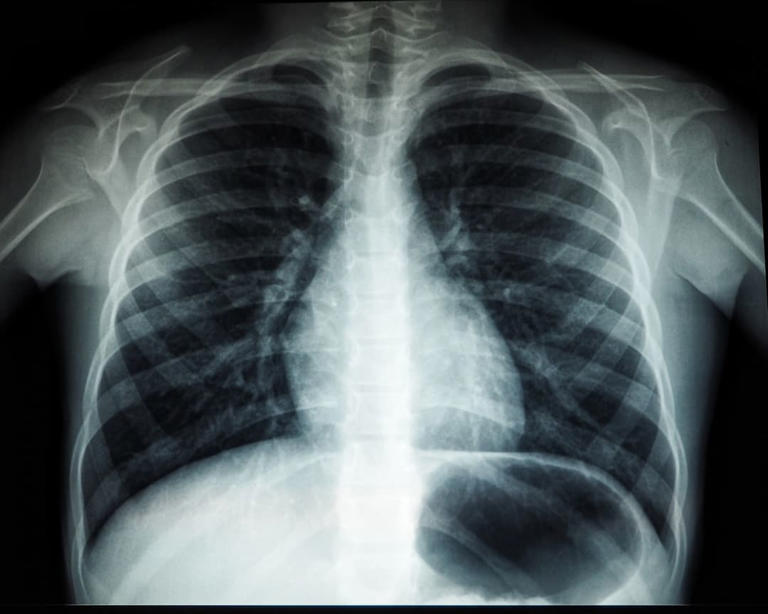 World Tuberculosis Day 2026: Respiratory physician shares differences ...