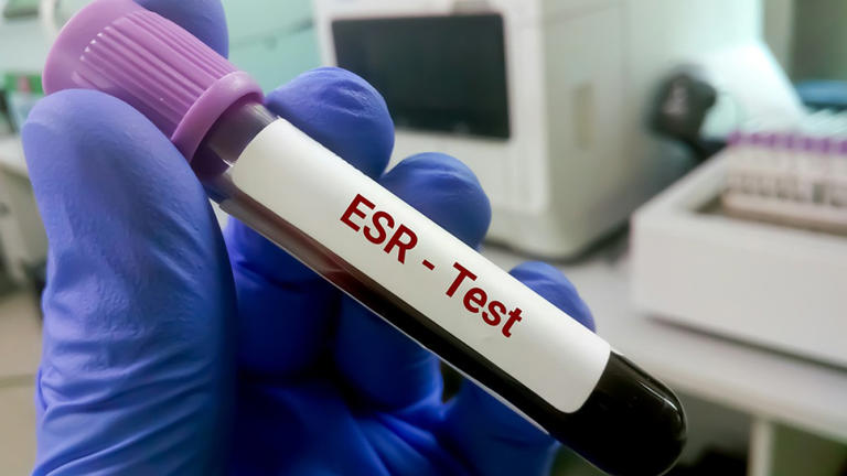 Study examines whether dropping ESR tests actually lowers costs
