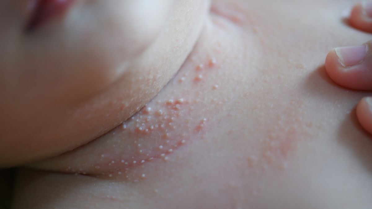 Are those tiny, shiny bumps on your skin in summer dangerous?