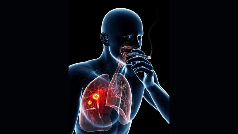 TP53 mutation and smoking emerge as warning markers in fast-growing ...
