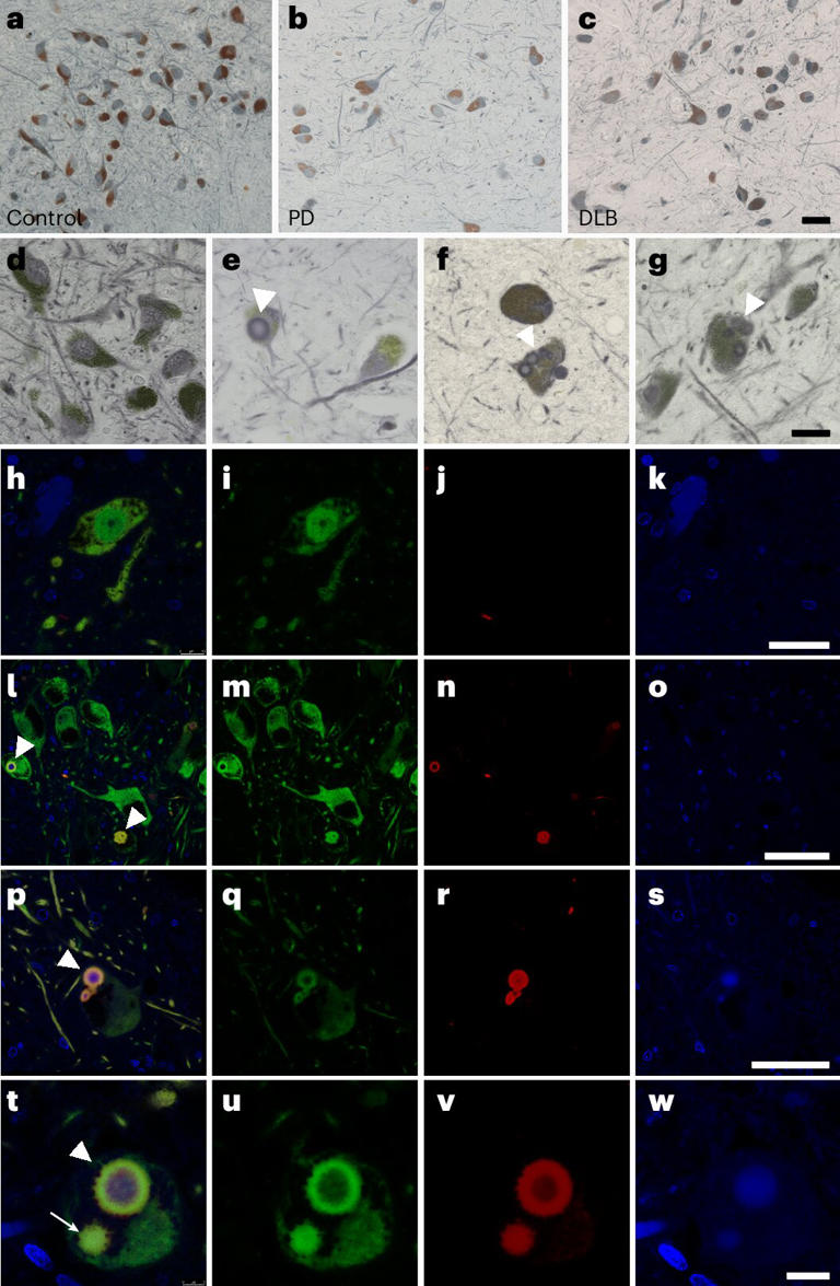 Cerebrospinal fluid biomarker improves diagnosis of Parkinson's disease ...