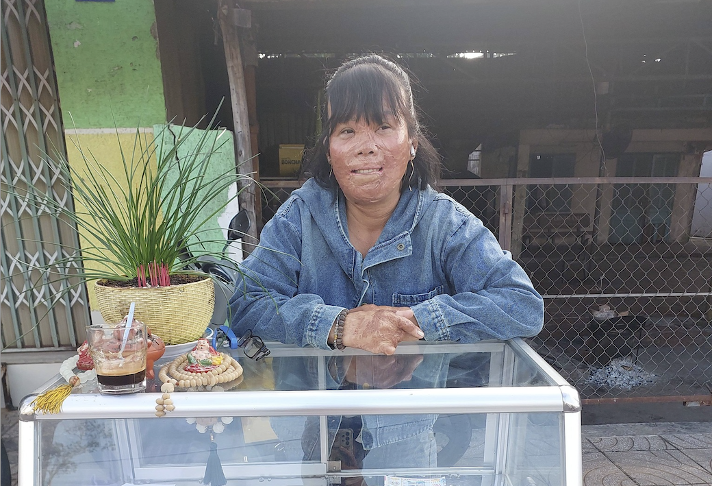 Hạnh phúc muộn của mẹ đơn thân bị bỏng 78%