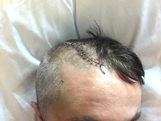 Mr Wallace has undergone several operations since his brain injury in 2019 (Supplied)