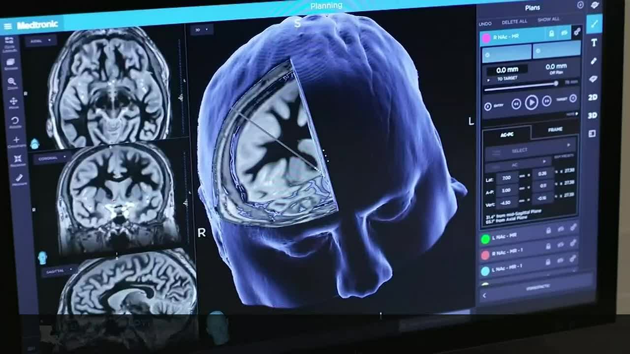 Free Parkinson’s screening being offered Friday