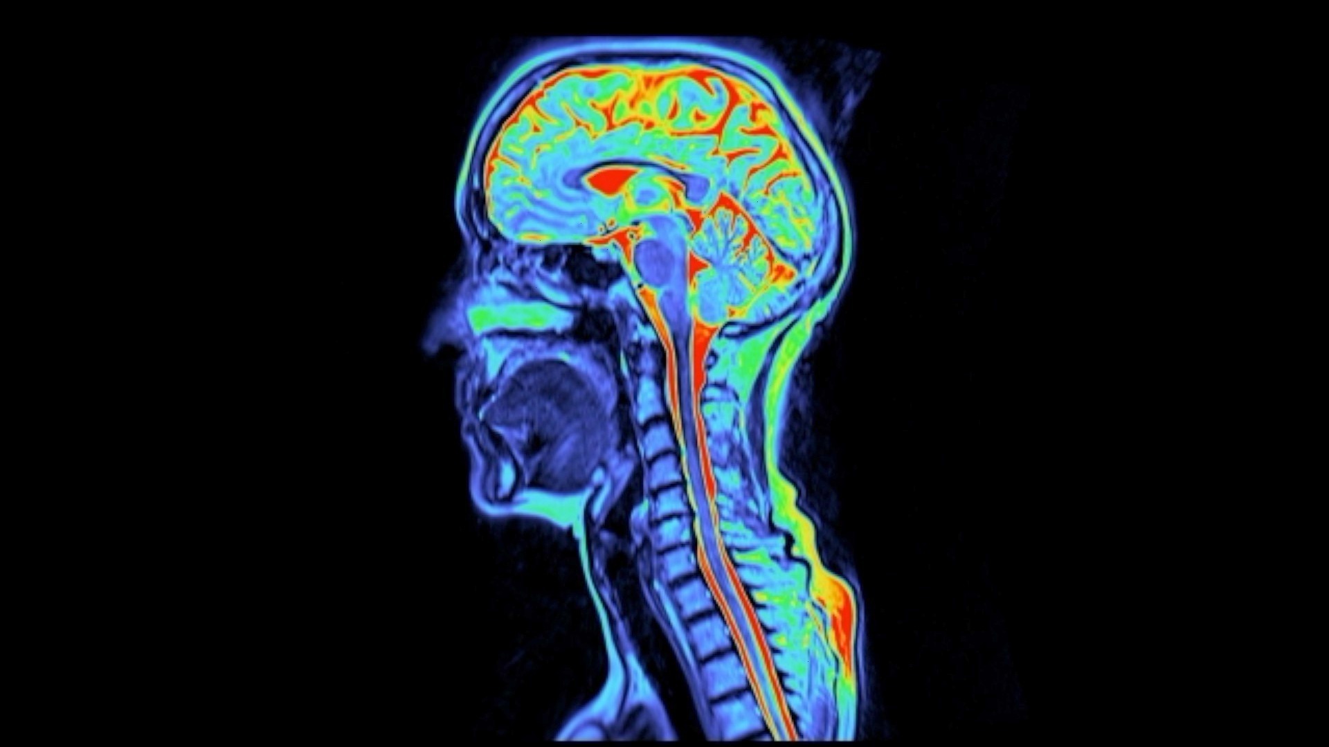 Long COVID brain changes echo chronic fatigue syndrome patterns
