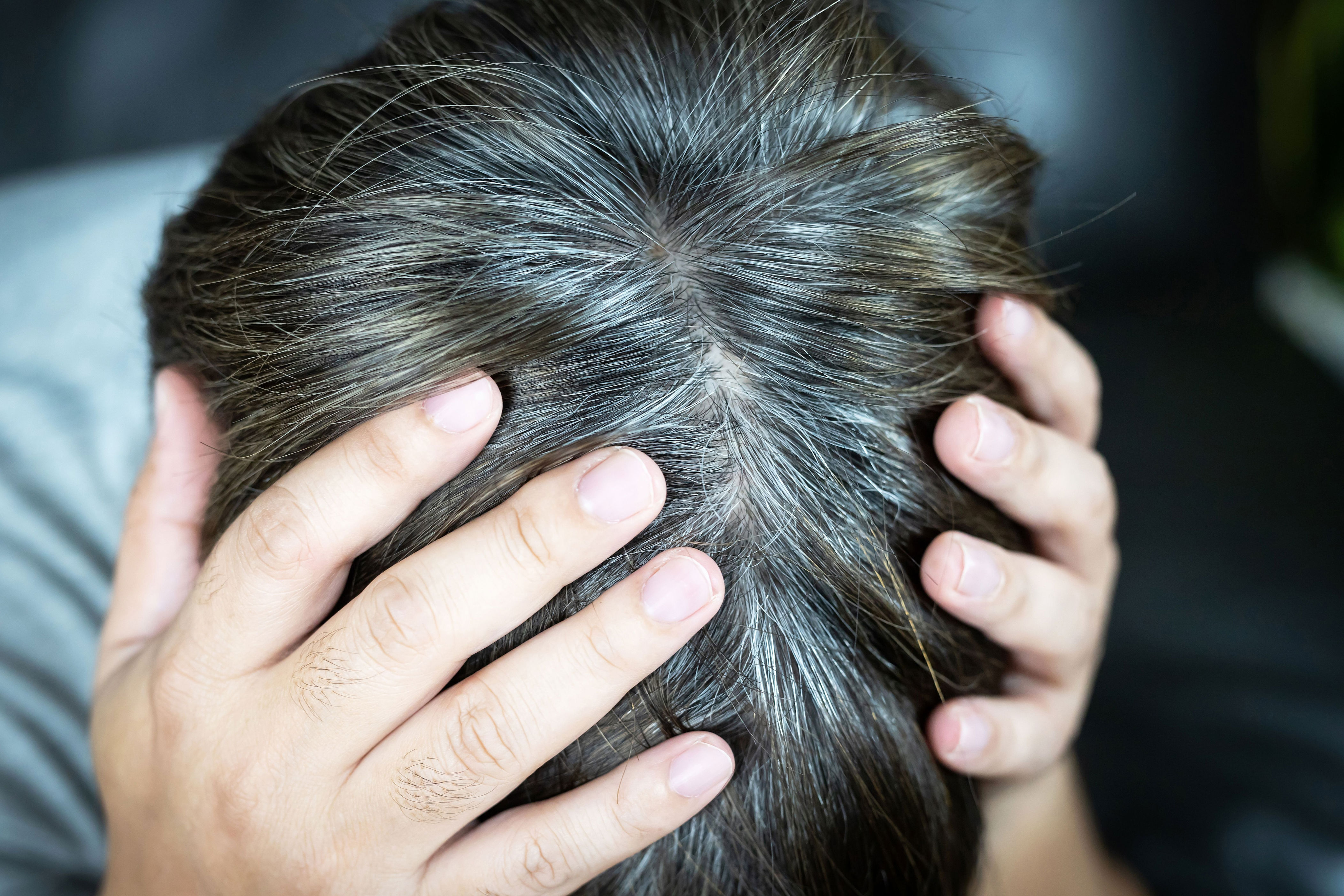 Porque pica el cuero cabelludo y se cae el pelo