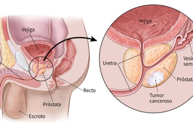 datos importantes que debe conocer del cáncer de próstata