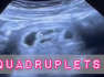 Amazing REACTION to Ultrasound revealing QUADRUPLITS!