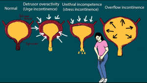 Urinary incontinence is  Involuntary loss of urine.
Urinary incontinence is common among older adults, but many of them do not disclose this symptom voluntarily even with doctors.
Urinary incontinence can be related to  Stress: like,  leakage of urine upon coughing, sneezing, or standing.
Or It can be related to urgency: urgency and inability to delay urination.
Urinary incontinence can be  temporary or transient. 
Different conditions can cause transient incontinence:
Delirium, it is a serious disturbance in mental abilities that results in confused thinking and reduced awareness of the environment. Most patients in hospital care have urinary incontinence because of delirium.
Urinary Tract infection:  can cause  urgency and incontinence.  Infection should be symptomatic to cause incontinence.  Just existence of bacteria in the urinary tract can without symptoms can not cause incontinence.  
Medications: Potent diuretics,  psychotropic medication,  calcium channel blockers, and anticholinergics can cause transient  incontinence. 
Alpha Blockers in women and alpha agonists in men also can cause incontinence. 

Severe depression and psychomotor retardation can cause transient incontinence. 
Excess urinary output: Excessive fluid intake,  hyperglycemia, diabetes insipidus and intaking diuretics can cause urinary incontinence. 
 Prolonged immobility, movement restriction and  stool impaction can also be cause of  transient urinary incontinence. 
 If Incontinence is not transient it is called established incontinence. 
Frist we should exclude or manage transient incontinence:
Causes of established incontinence:

Detrusor overactivity (urge incontinence). 
At this case uninhibited bladder contractions and causes leakage. It is the most common cause of established incontinence.  And common among older adults.  Women will complain of urinary leakage after the onset of an intense urge to urinate that cannot be forestalled.
Among man the symptoms can be similar but commonly it coexist alongside with benign prostatic hyperplasia. 
Destructor overactivity can be caused bladder stones or tumor,  the abrupt onset of otherwise unexplained urge incontinence, especially if accompanied by suprapubic discomfort, should be investigated by urine cytology and cystoscopy. 
The cornerstone of treatment is  bladder training. Patients start by voiding on a schedule based on the shortest interval recorded on a bladder record. 
They then gradually lengthen the interval between voids by 30 minutes each week using relaxation techniques to postpone the urge to void.
Lifestyle modifications:
including weight loss and caffeine reduction, may also improve incontinence symptoms.
Pelvic floor muscle (“Kegel”)  exercises can reduce the frequency of incontinence episodes when performed correctly and sustained.
Anticholinergic drugs: anticholinergics (antimuscarinic drugs) - eg, oxybutynin, propiverine, tolterodine are effective against overactive bladder. 
Immediate-release non-proprietary oxybutynin is the most cost-effective of the available options.
Intravaginal oestrogens: these can be used  in postmenopausal women who have vaginal atrophy.

Urethral incompetence (stress incontinence)
It is the second most common cause of established urinary incompetence in older woman. 
It can be occur in men after radical prostatectomy.
Such incontinence occurs in response to an increase in intra abdominal pressure. 
For example during laughing, lifting heavy objects or coughing. 
Pelvic muscle exercises are effective for women with mild to moderate stress incontinence. Instruct the patient to pull in the pelvic floor muscles and hold for 6–10 seconds and to perform three sets of 8–12 contractions daily. Benefits may not be seen for 6 weeks.
Medications:
The first line of therapy for urethral incompetence are medications: alpha agonists, estrogens, and GnRH (gonadotropin-releasing hormone) analogues. 
Alpha-adrenergic agonists, such as PPA (phenylpropanolamine) and ephedrine, function by increasing the tone of urethral smooth muscle.
Alpha adrenergic agonists can  be used alongside estrogens. 
(diethylstilbestrol is most commonly used estrogen.)

Overflow incontinence—Urethral obstruction (due to prostatic enlargement, urethral stricture, bladder neck contracture, or prostatic cancer) is a common cause of established incontinence in older men but is rare in older women. 
It can present as dribbling incontinence after voiding, urge incontinence due to detrusor overactivity, or
overflow incontinence due to urinary retention. 
It may be idiopathic or have an identifiable cause including medications and sacral lower motor nerve
dysfunction. When it causes incontinence, detrusor underactivity is associated with urinary frequency, nocturia, and frequent leakage of small volumes.