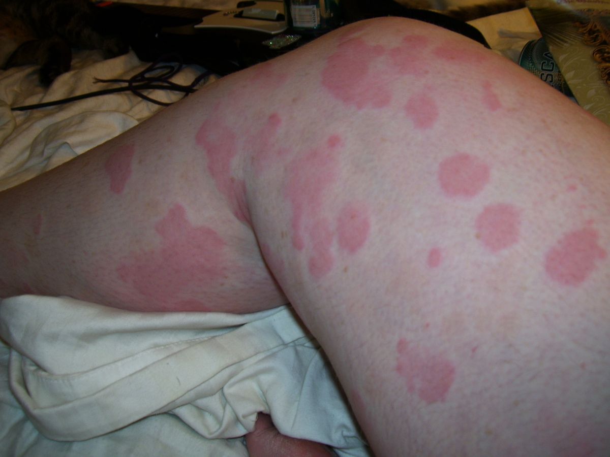 These Pictures Will Help You Identify the Most Common Skin Rashes