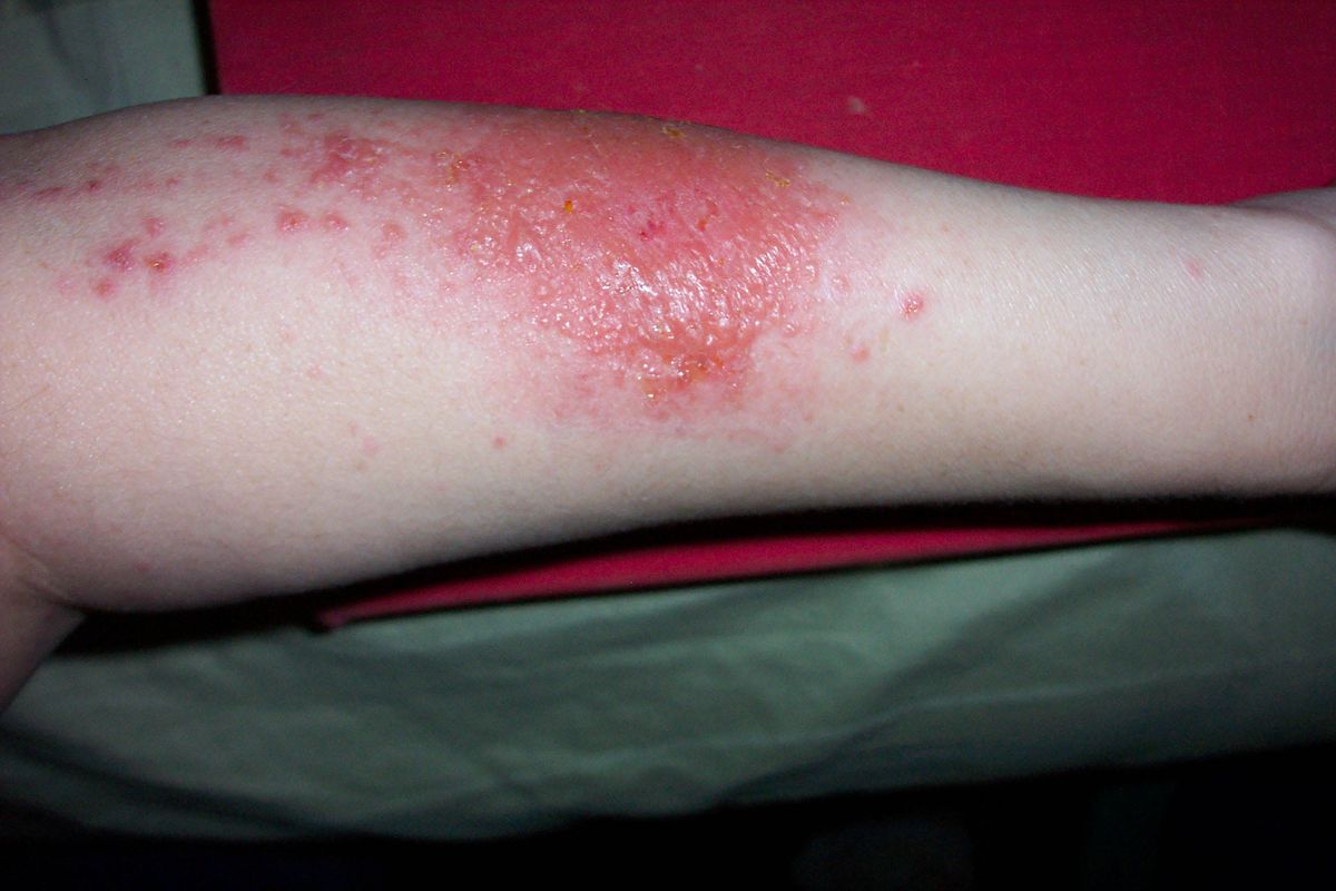 These Pictures Will Help You Identify the Most Common Skin Rashes