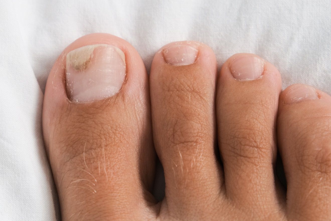 remedio casero para eliminar los hongos de las uñas de los pies