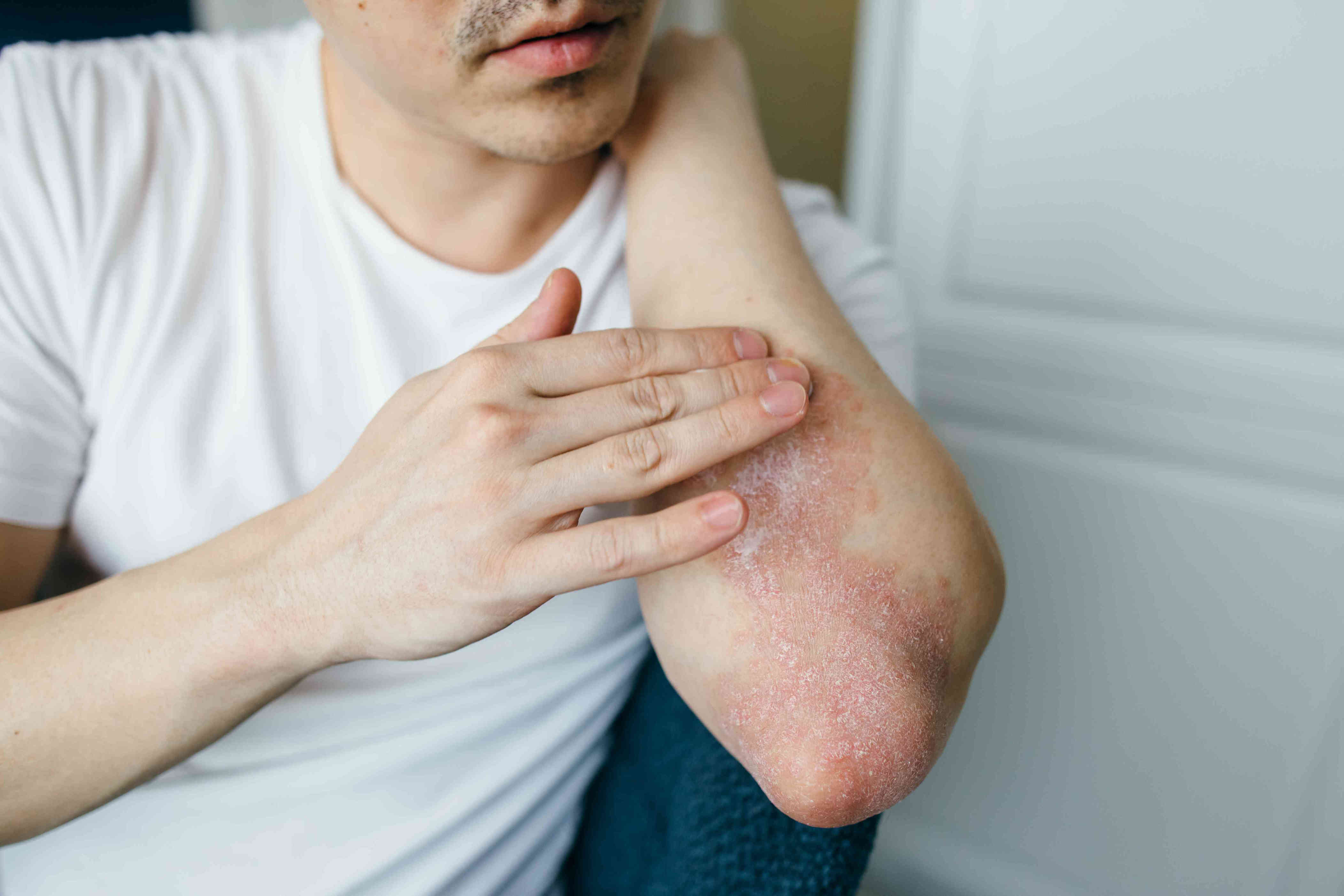 How To Stop Scratching Eczema