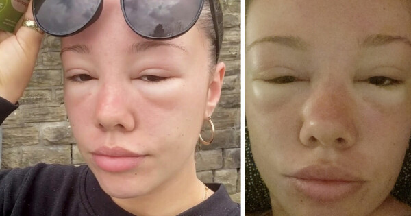 orla, 22, fick solförgiftning mitt under semestern – nu varnar hon för vanliga missen: ”dumt”