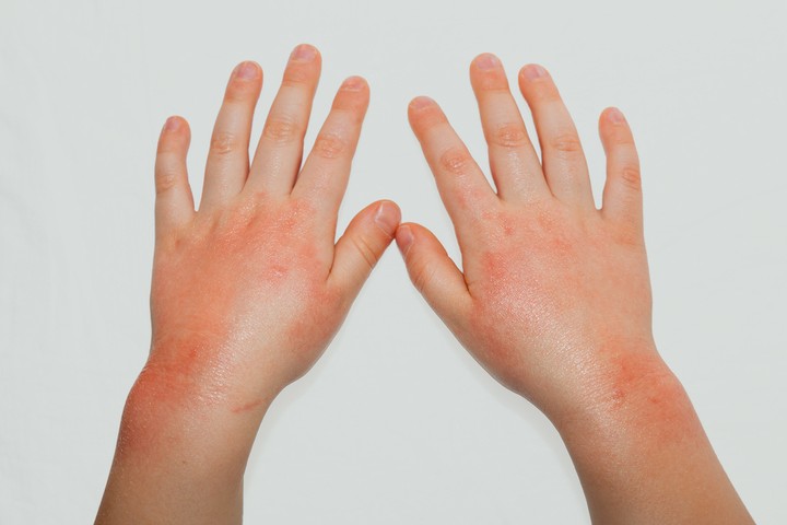 penyebab dermatitis numularis seperti yang dialami anak aurel hermansyah