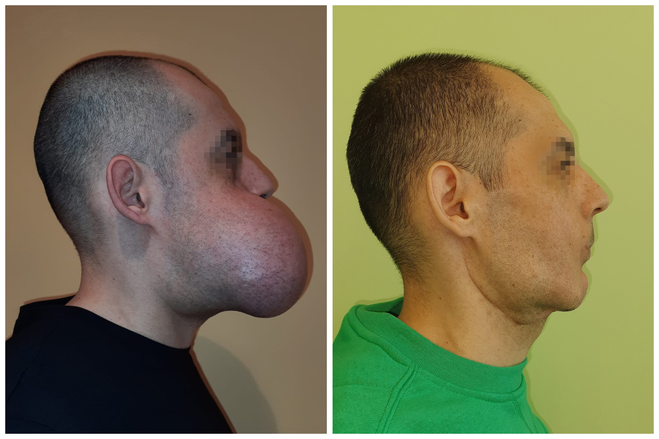Man Has 3-Pound Tumor Successfully Removed From Face After 20 Years