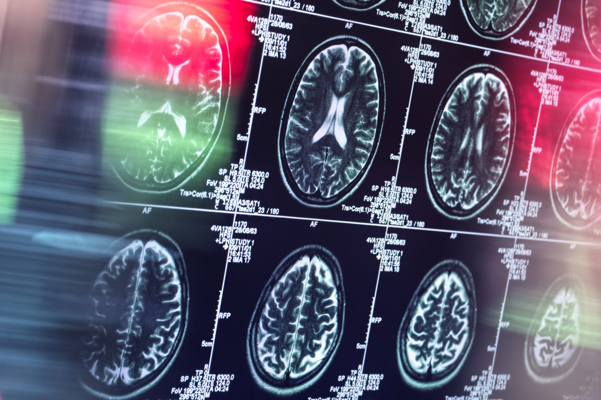 Caused by brain damage