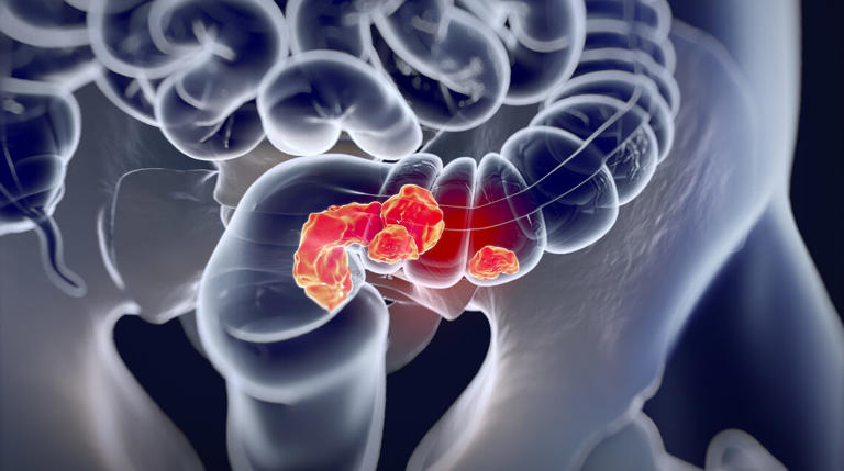 Algumas vezes os sintomas de câncer de cólon podem não receber a atenção que precisam