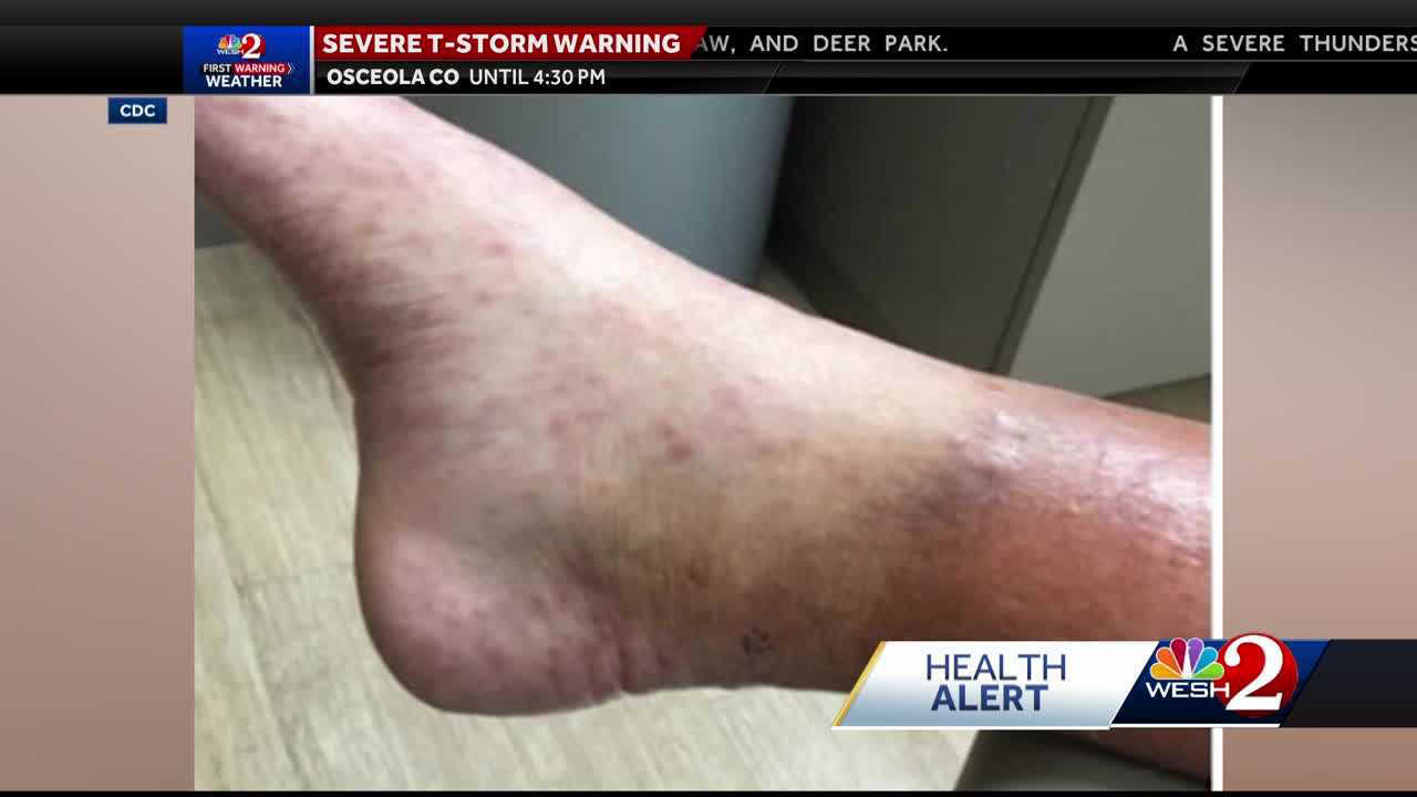 Leprosy cases surging in Central Florida CDC