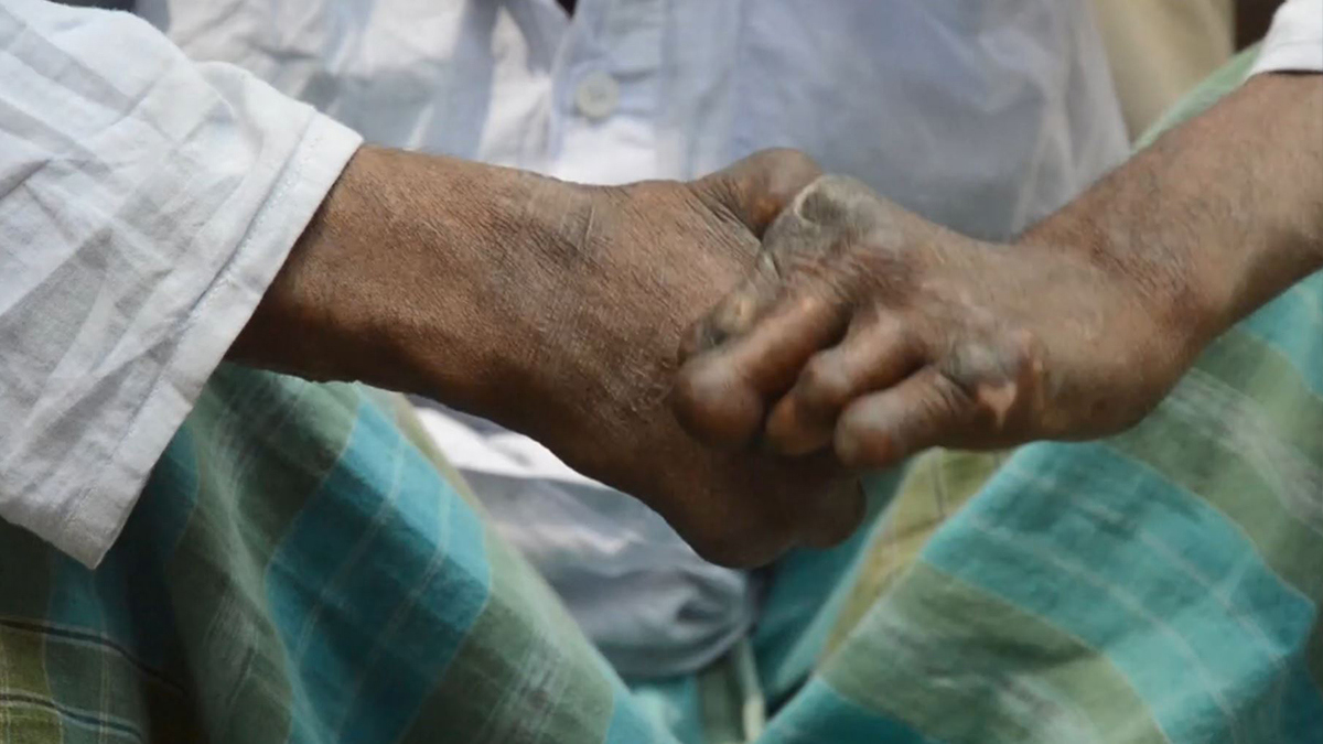 Florida accounts for almost onefifth of leprosy cases in the US CDC