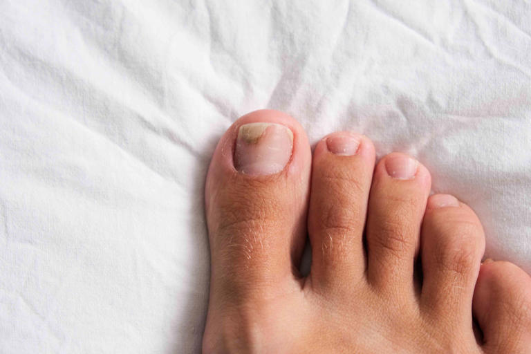 What Are The Different Types Of Toenail Fungus