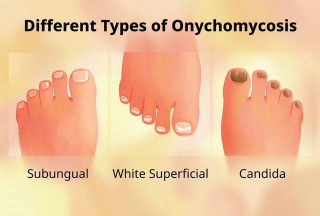 What Are The Different Types Of Toenail Fungus?