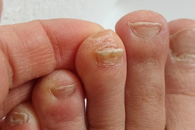 What Are The Different Types Of Toenail Fungus?