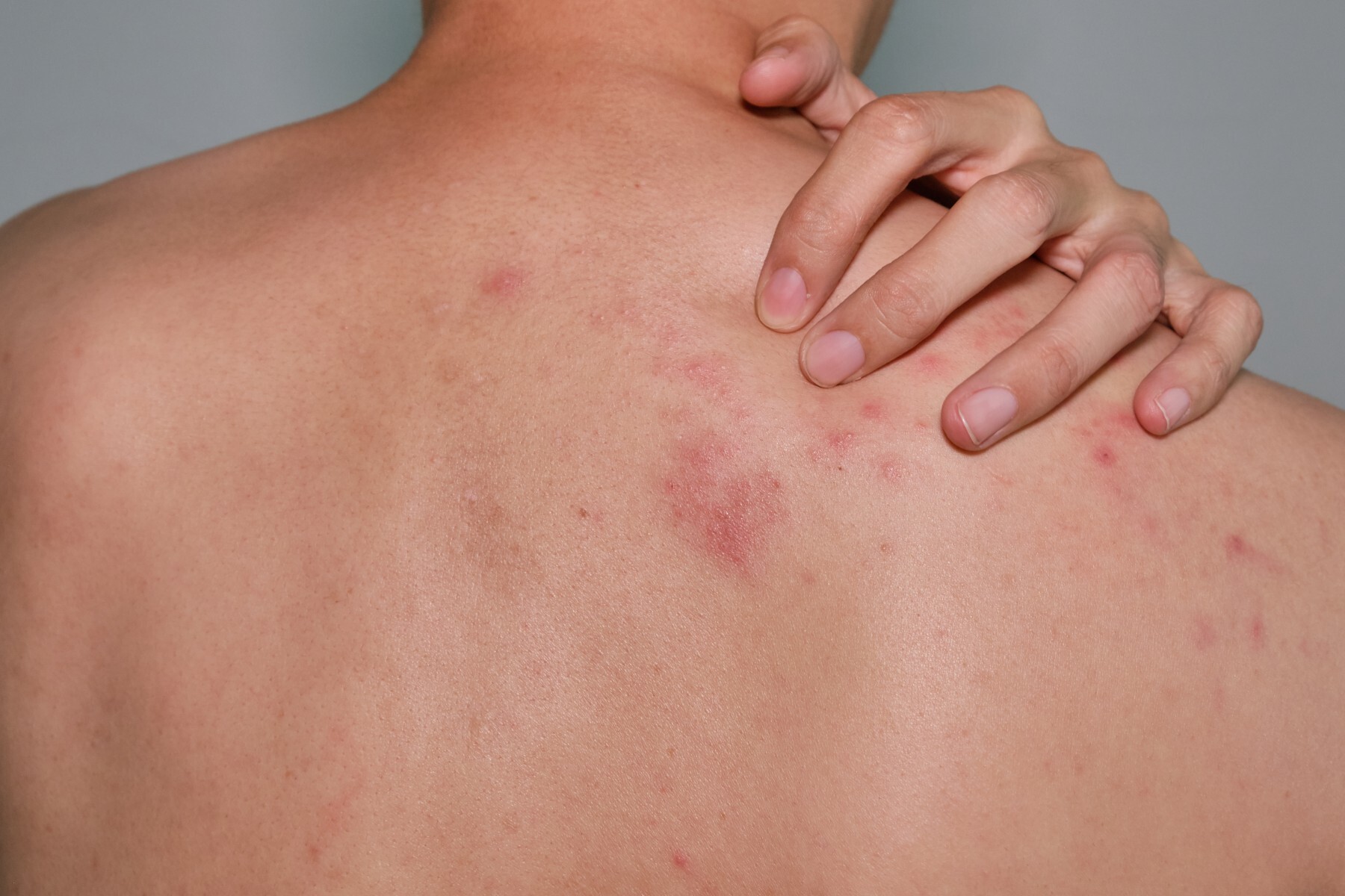 Shingles: what are the symptoms and treatment?