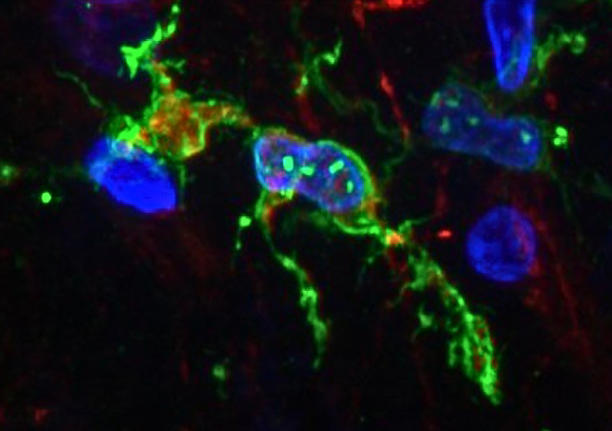 Photomicrograph of microglia (green) from a brain affected by Alzheimer's. (Lexi Cochoit/UW Neuroinflammation Lab)