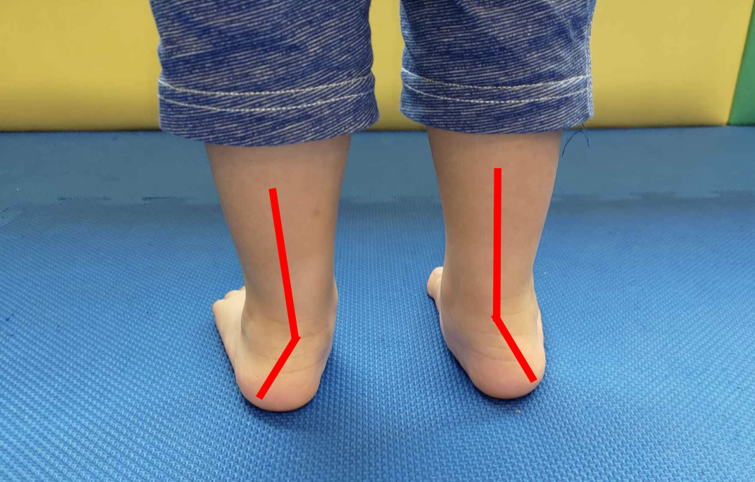薛千川醫師說明，從後方觀察孩子的足跟，若足跟往外側彎曲，就可能是扁平足   圖：恩主公醫院/提供