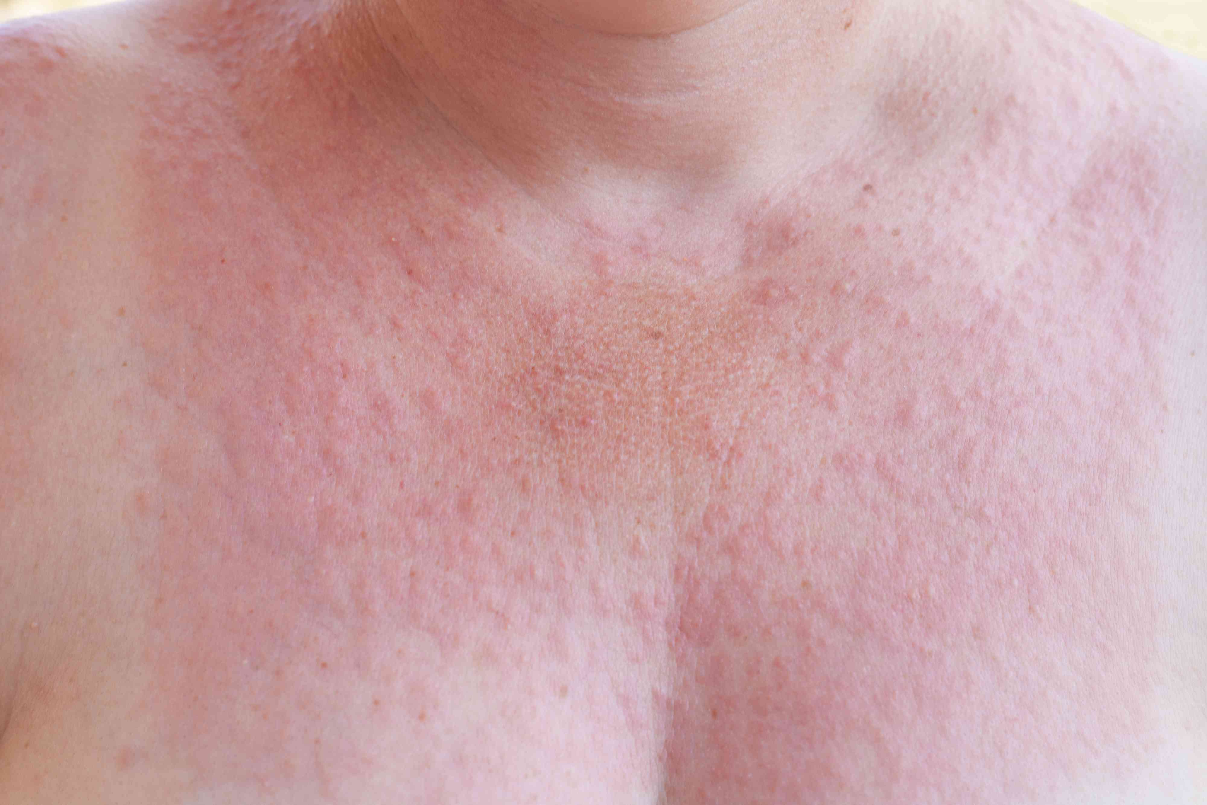 зуд на коже груди у женщин фото 39