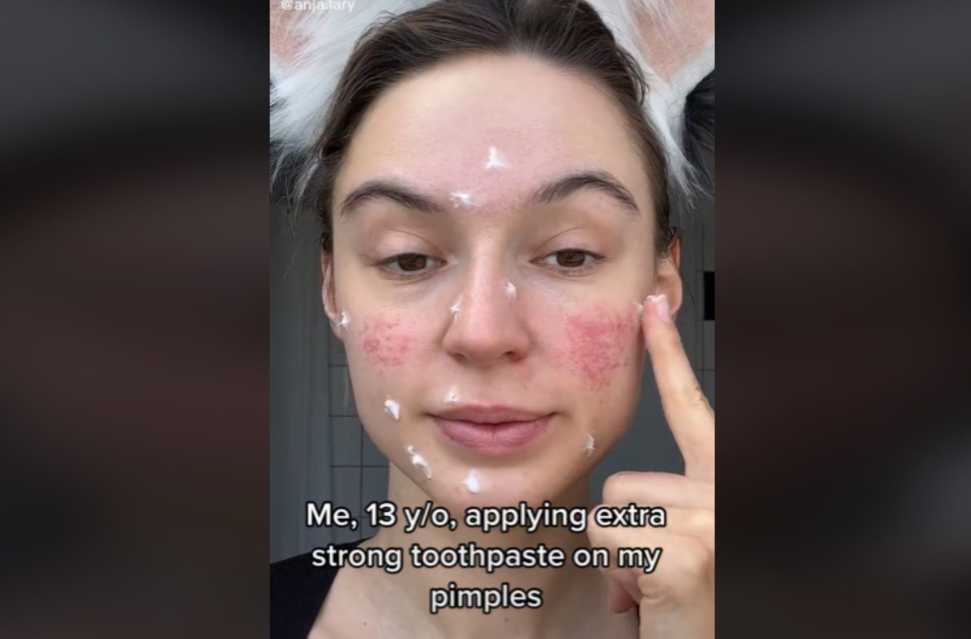 forget-the-celebrity-miracle-cures-here-s-how-to-really-clear-acne