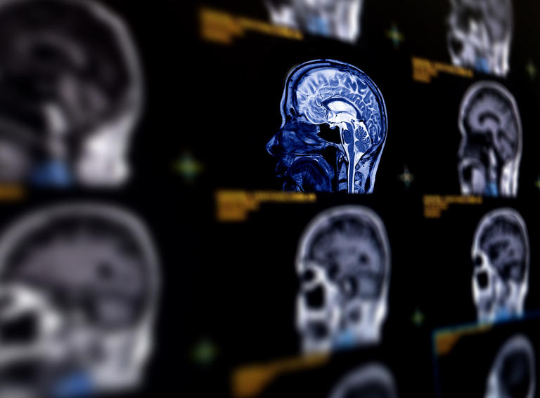 Selective focus of MRI brain sagittal plane for detect a variety of conditions of the brain such as cysts, tumors, bleeding, swelling, developmental and structural abnormalities or infections .