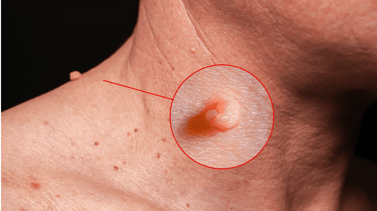 El VPH suele dejar marcas en la piel como verrugas.