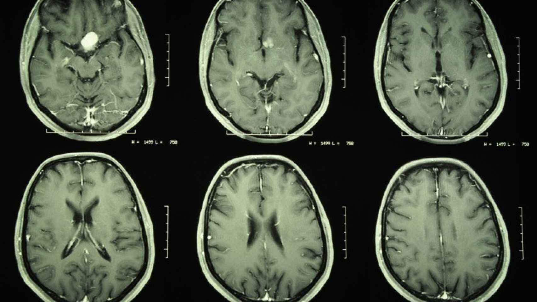 Менингиома гамма нож. Менингиома кавернозного синуса мрт. Опухоль головного мозга фото. Менингиома головного мозга кт. Опухоль головного мозга на кт.