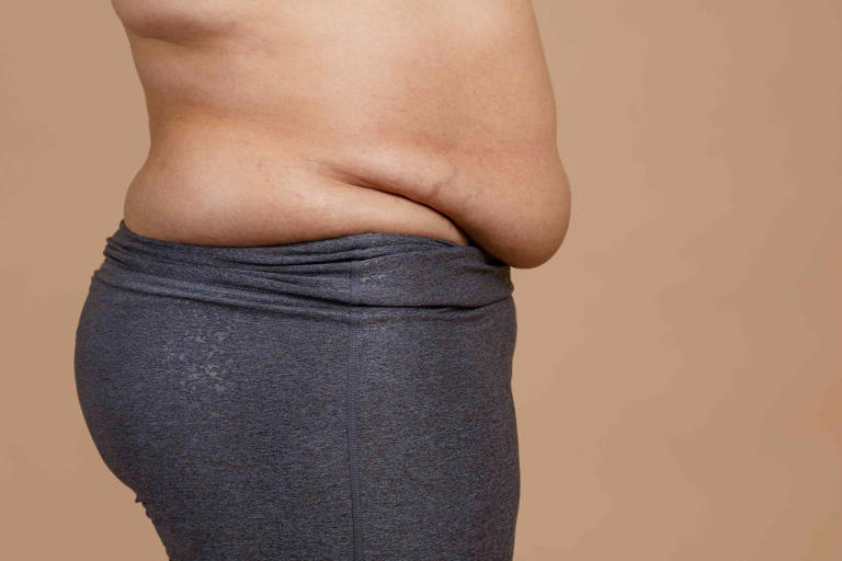 What is apron belly and how can I eliminate it?