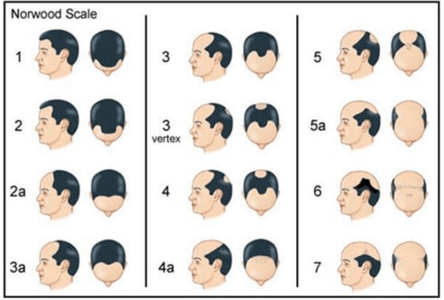 雄性禿通常分為7期，醫師建議第3、4期就做植髮，效果較佳。（圖：彭家盈醫師提供）