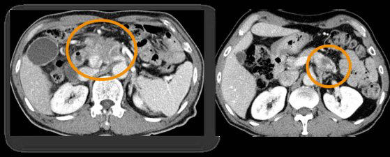 췌장암 환자의 복부 컴퓨터단층촬영(CT) 사진. 사진 병원 제공