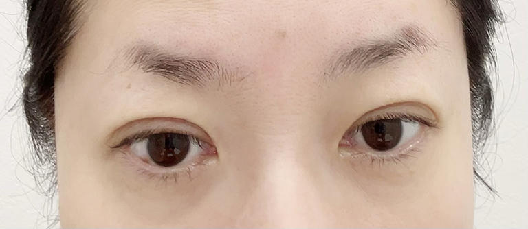 眼瞼皮膚弛緩症のМさん(56）の手術直後