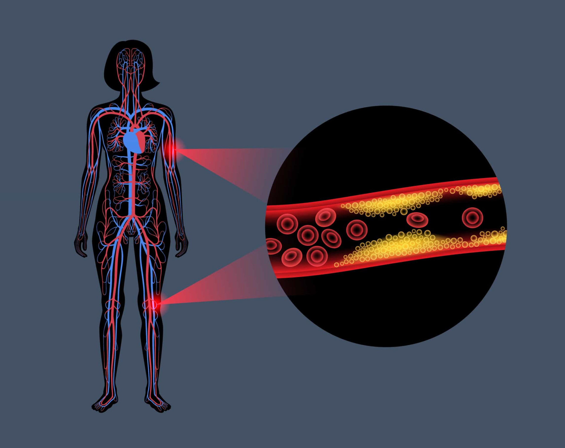 What is peripheral artery disease, and are you at risk?