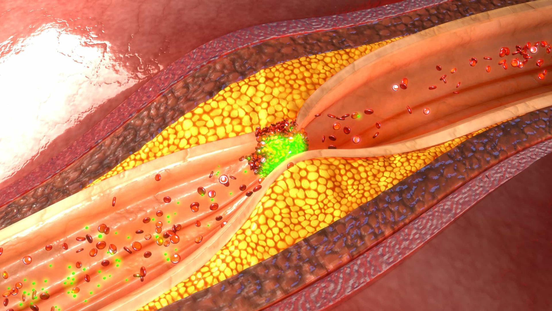 What is peripheral artery disease, and are you at risk?