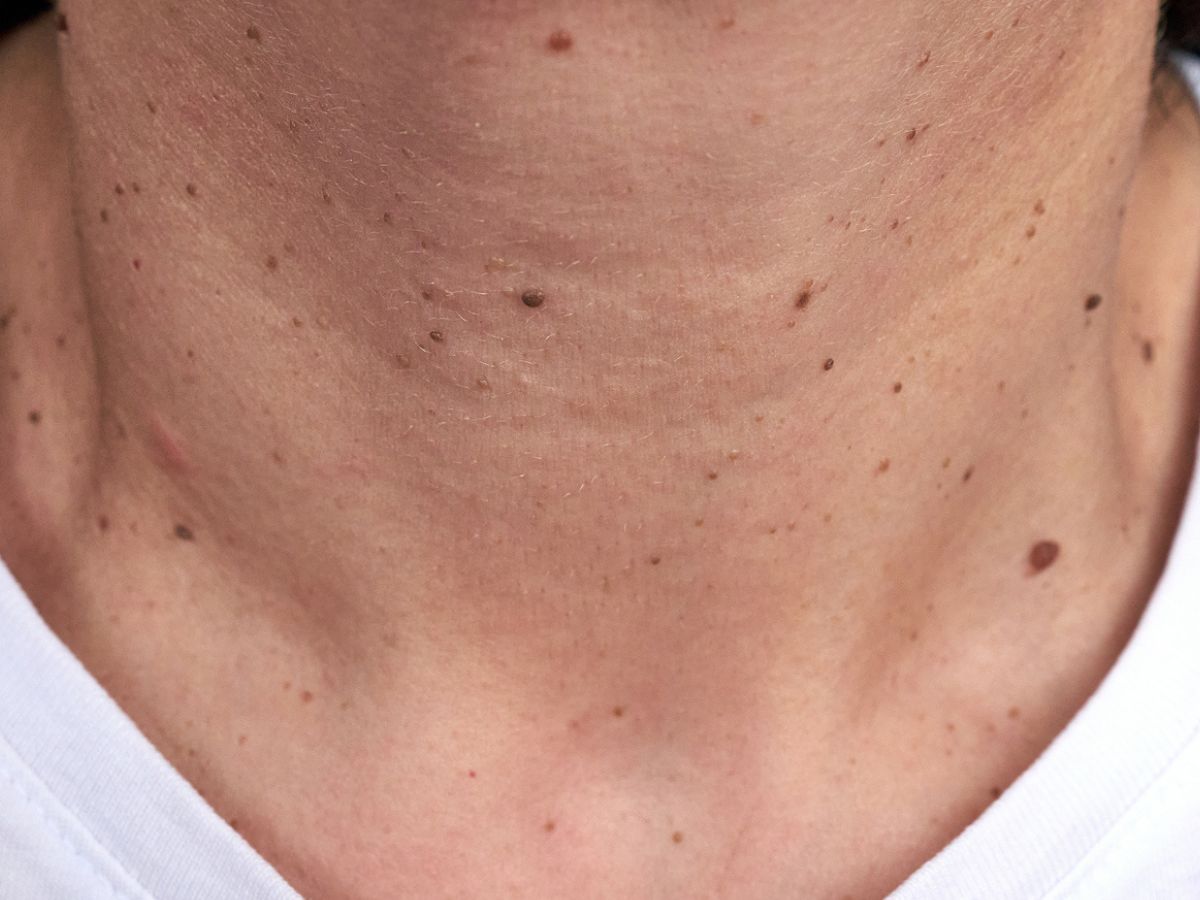 3 problemas de salud que causan verrugas en el cuello: elimínalas sin lastimar la piel