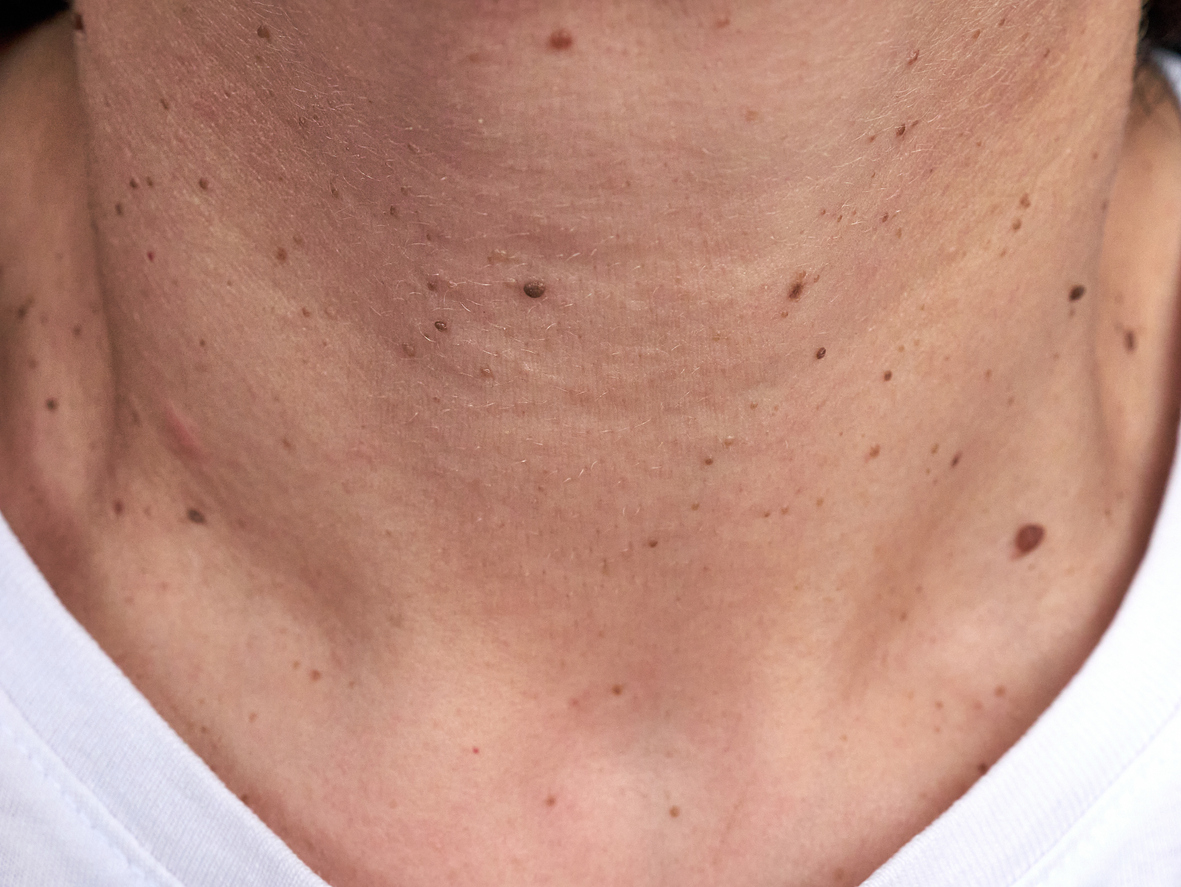 3 problemas de salud que causan verrugas en el cuello: elimínalas sin lastimar la piel