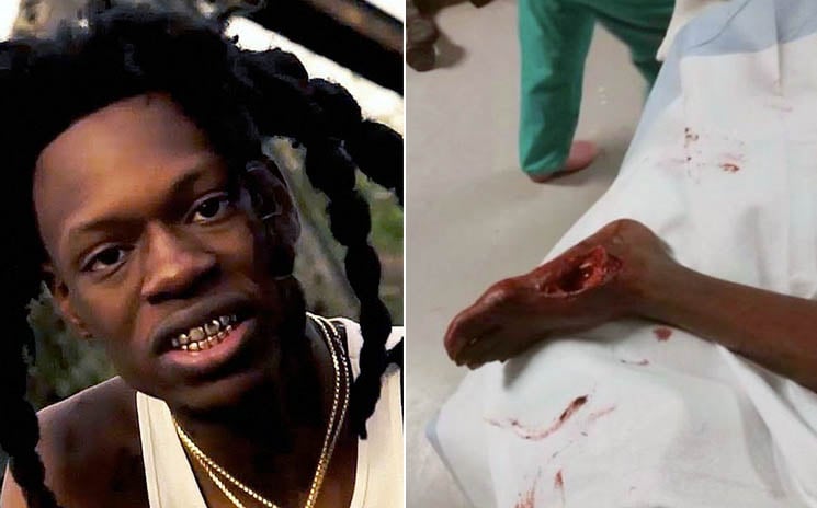 Ewww Drill Rapper Julio Foolio S Foot Is Saved But Gruesome Photo Of   AA1iXZek.img