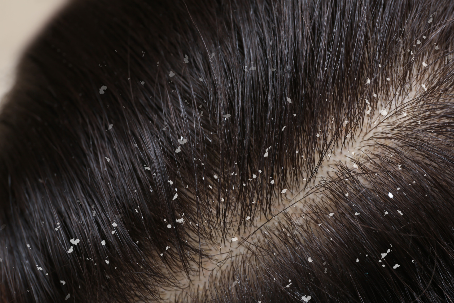 Here's how to really deal with dandruff