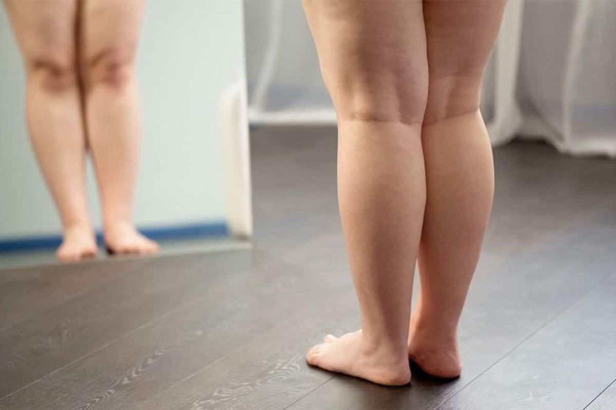 Sinais do lipedema: conheça os 5 principais