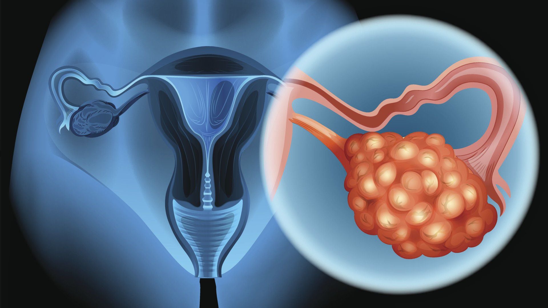 estos son los síntomas del cáncer de ovario, enfermedad que padeció elianis garrido