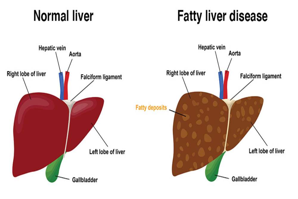 mengenal gejala, penyebab dan cara pencegahan fatty liver, bisa berubah jadi kanker hati