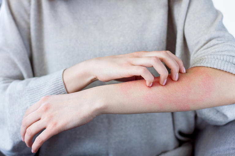 Can stress cause a rash? What to know about anxiety and skin